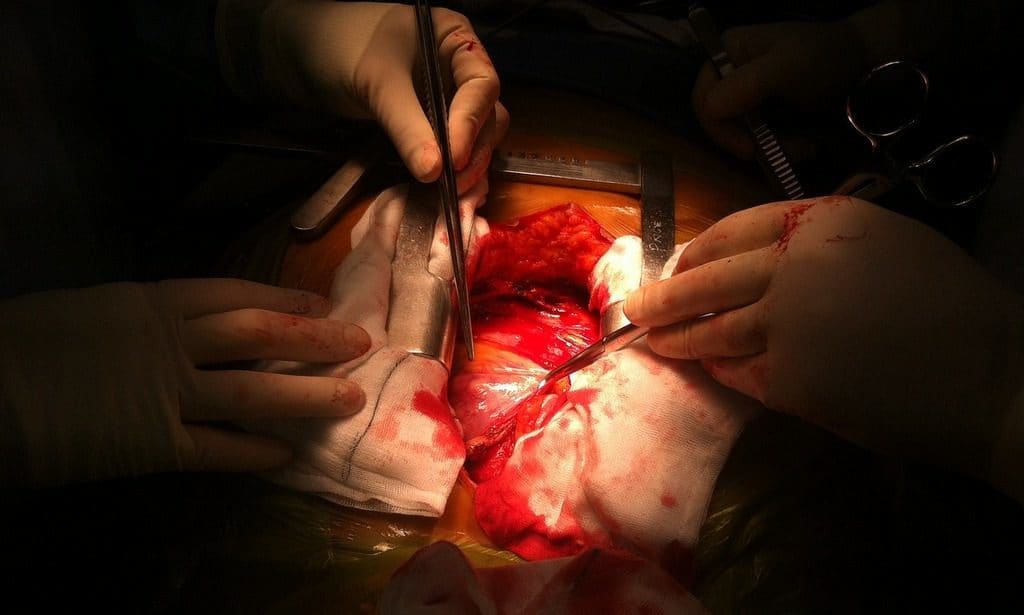Heart surgery